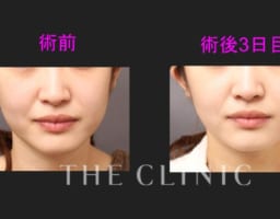 実はあんまり腫れない 顔の脂肪吸引の術後3日の写真を公開 The Clinic東京院スタッフブログ