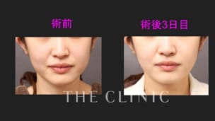 顔の脂肪吸引の術前後比較