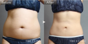お腹の脂肪吸引の症例画像（20代女性）