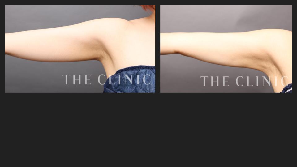 二の腕の脂肪吸引の症例画像