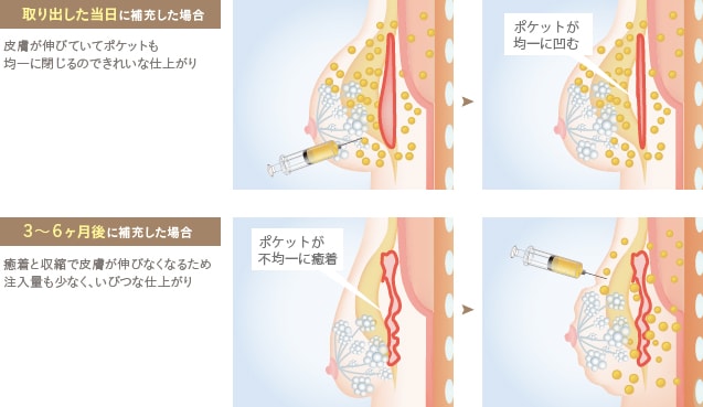 シリコンバッグ除去と脂肪注入は同日が良い理由