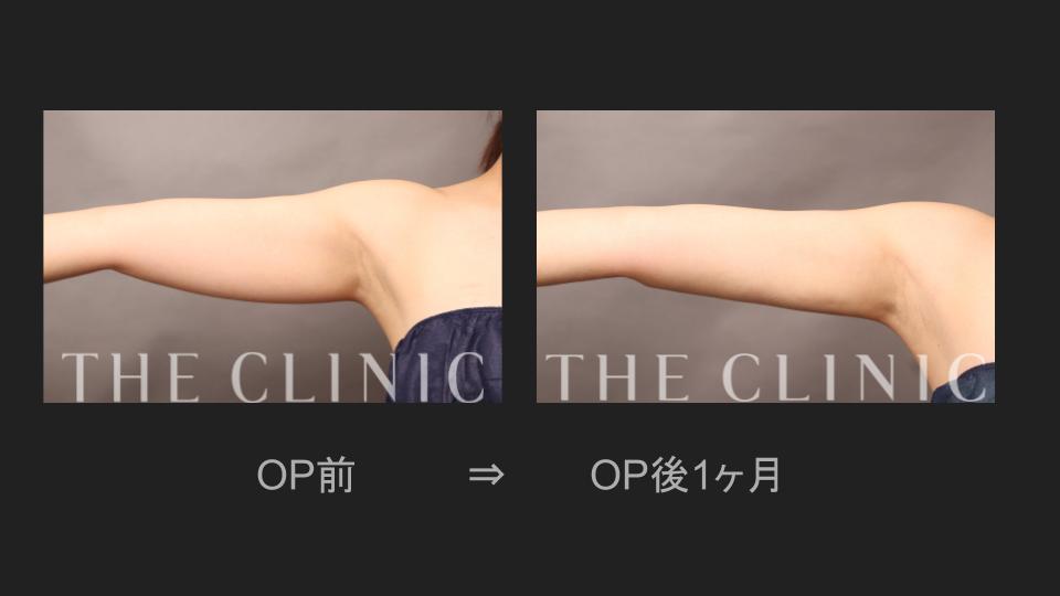 二の腕の脂肪吸引の症例画像