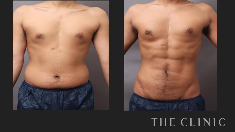 男性の腹部脂肪吸引の症例ビフォーアフター