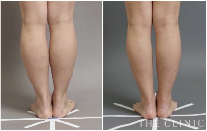 足（ふくらはぎ）の脂肪吸引の症例画像
