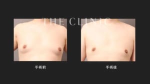 女性化乳房の治療症例