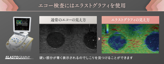 乳腺用エコー「エラストグラフィ」の見え方と通常エコーとの違い